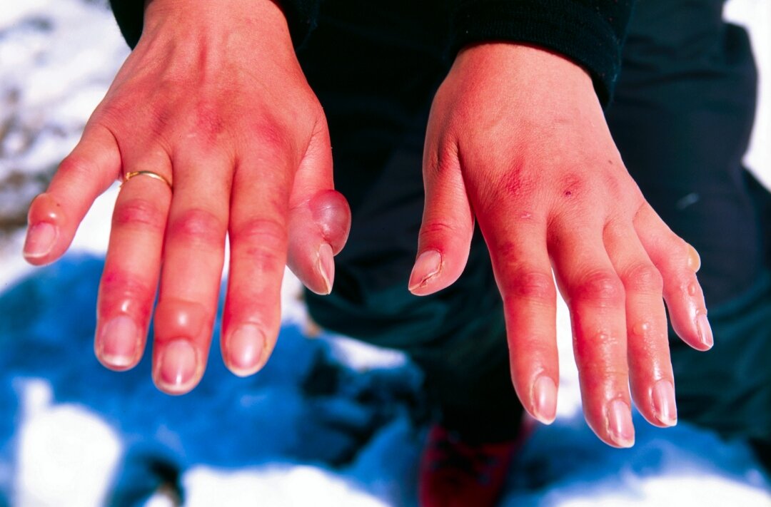 If your hands look like this, then you've got a case of frostbite.
